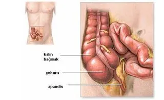 Apandisit
