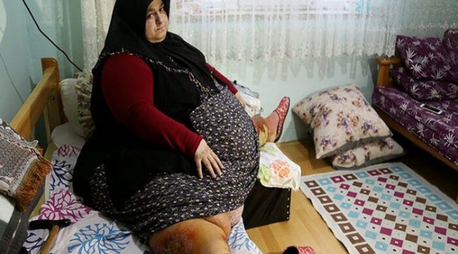 Sakarya’da yaşayan ve 250 kilo olan Sevim Bal obezite ameliyatı ile 95 kiloya düştü