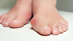 Ayak üstünde kemik çıkıntısı nedenleri | Ayak kemiği çıkıntısı tedavisi
