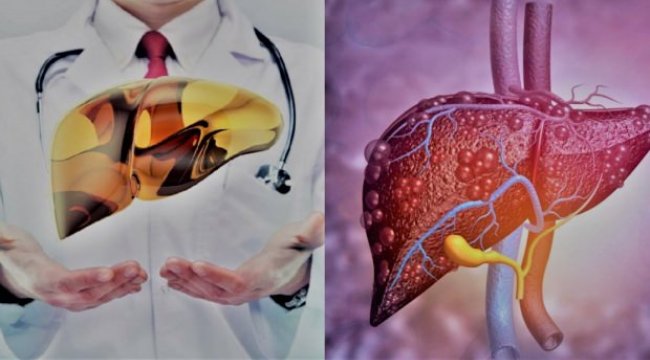 Karaciğer Yağlanması belirtileri, bitkisel tedavi: Temizleyen yiyecekler?