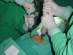 Akciğer cerrahisi