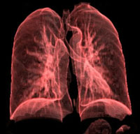 Akciğer kistleri