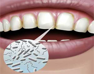 Her şeyin suçlusu mikrobiyal dental plak