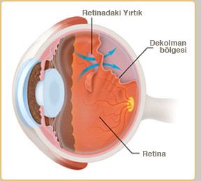 Dekolman nedir? Dekolmanın belirtileri nelerdir? Dekolmanın tedavisi nedir?