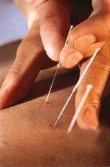 Akupunkturun nasıl iğne ?