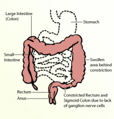 Hirschsprung hastalığı