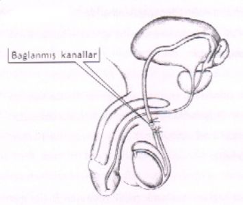 Erkekte kanalların bağlanması (vazektomi) nedir?