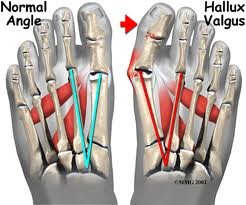 Ayak başparmağında çıkıntı halluks valgus