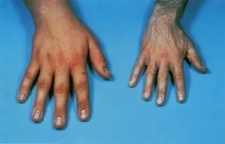 Akromegali: kontrolsüz büyüme hastalığı