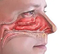 Septum deviasyonu