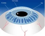 Kornea nakli ne zaman yapılır?