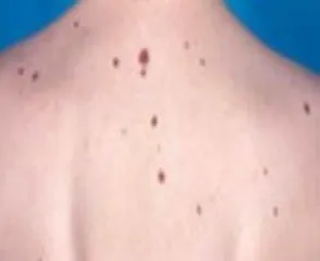 Benler ile ilgili doğru ve yanlışlar