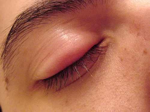 Arpacık ( Hordeolum = İtdirseği )