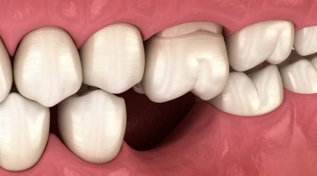 EKSİK DİŞLER ÇENE YAPISINI BOZAR MI?