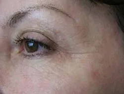 A vitamini – kırışıklık savaşçısı