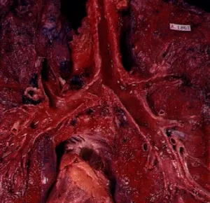 Akciğer tümörleri