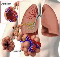 Amfizem