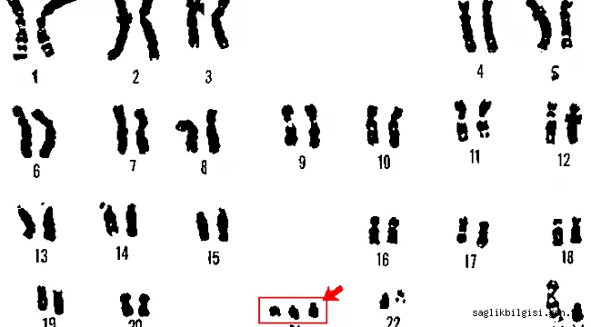 Down sendromu ( Mongolizm ) nedir?