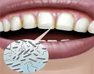 Her şeyin suçlusu mikrobiyal dental plak