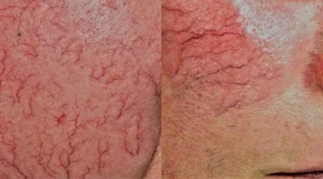 Kılcal damar çatlaması evde bitkisel tedavisi: Lazer tedavisiyle geçer mi?