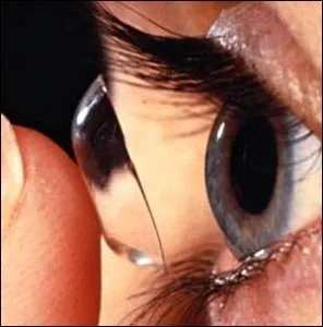 Kontakt lens (Değen mercek)