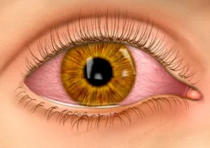 Uçuk mikrobuna bağlı göz hastalıkları