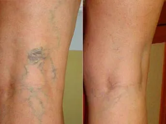 Varis tedavisi için geç kalmayın?